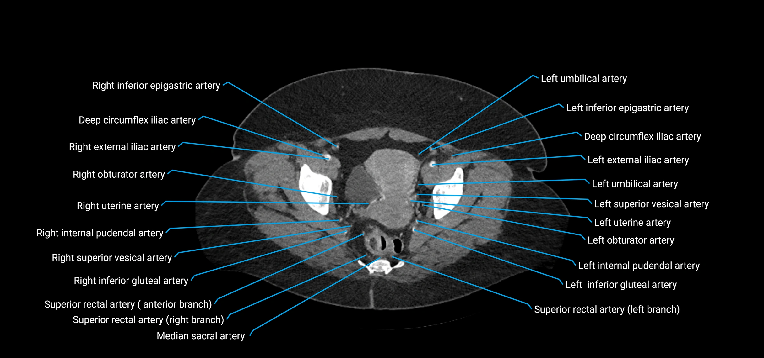 CTA abdomen axial cross sectional anatomy labelled image_228 (2).webp